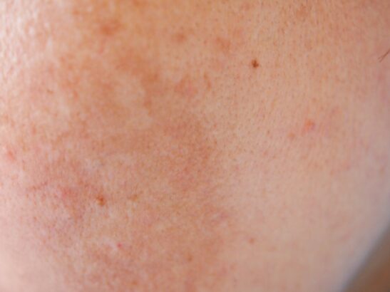 pigmentations hormonales